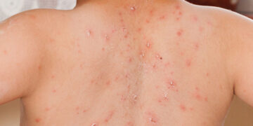 Jangkitan Campak Pada Kanak-Kanak & Dewasa: Simptom, Rawatan dan Vaksin