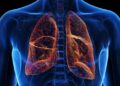 Cystic Fibrosis: Causes, Symptoms, and Treatment Options