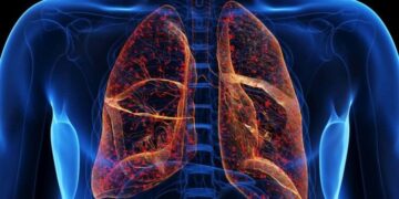 Cystic Fibrosis: Causes, Symptoms, and Treatment Options