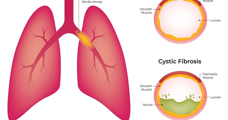 Cystic Fibrosis