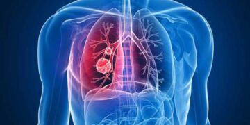 Kanser Paru-Paru: Tanda Awal yang Tidak Boleh Diabaikan