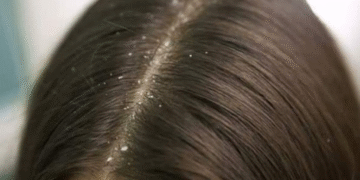 Cara Hilangkan Kelemumur dalam Beberapa Langkah Mudah