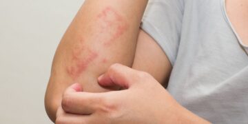 Kulit Merah & Gatal? Fahami Masalah Kulit Ruam dan Solusinya