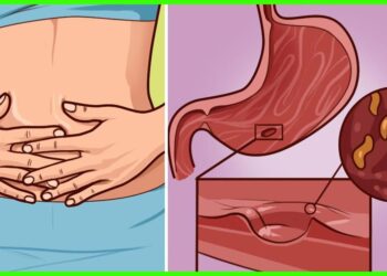 What Are The Natural Remedies For Intestinal Worms?