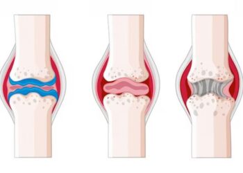 Kenapa Tulang Rawan Cepat Haus? 7 Cara Lindungi Sendi
