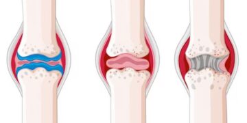 Kenapa Tulang Rawan Cepat Haus? 7 Cara Lindungi Sendi