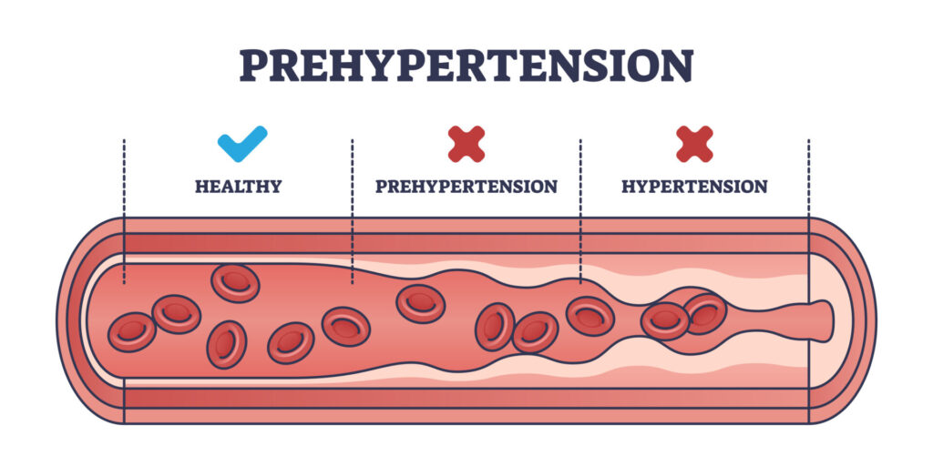 Early Signs of Hypertension