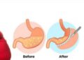 Risks Of Getting Bariatric Surgery