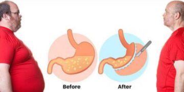 Risks Of Getting Bariatric Surgery