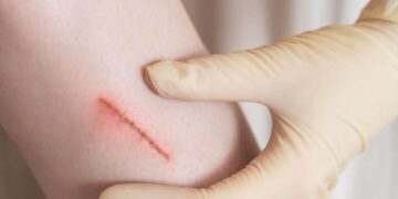 Cara Bersihkan Luka Jahitan dengan Betul: Elak Jangkitan & Parut