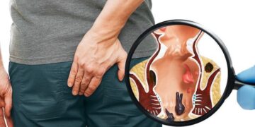 What Are The Treatments For Hemorrhoids?