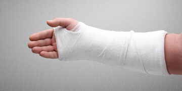 Cast Tangan: Cara Menjaga Kebersihan & Elak Jangkitan Kulit