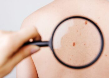 Early Signs of Skin Cancer