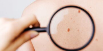Early Signs of Skin Cancer