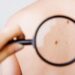 Early Signs of Skin Cancer