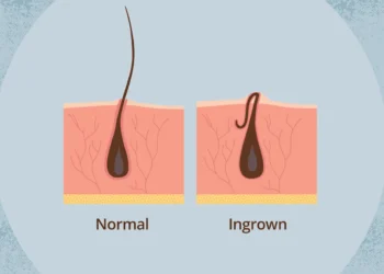 Fakta Tentang Ingrown Hair: Apa Yang Perlu Anda Tahu