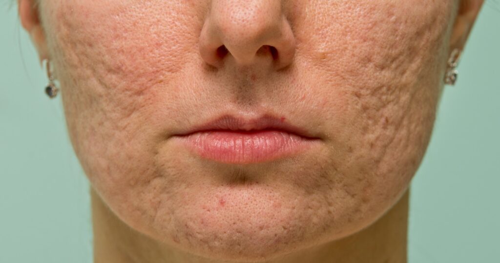 acne scars