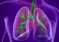 Chronic Obstructive Pulmonary Disease (COPD)