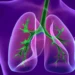 Chronic Obstructive Pulmonary Disease (COPD)