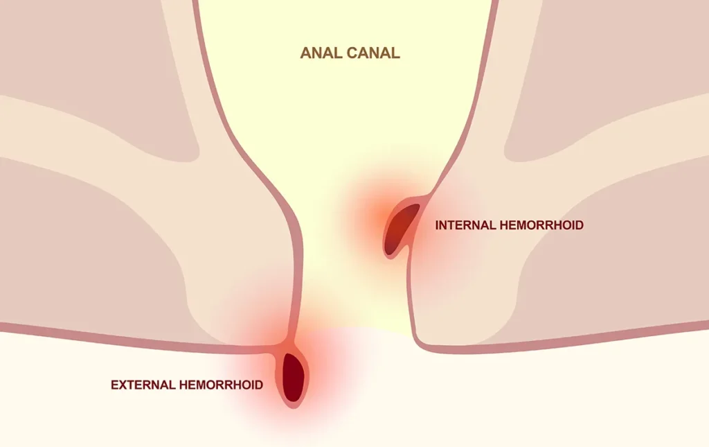Treatments For Hemorrhoids