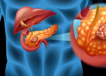 Symptoms of Pancreatic Cancer