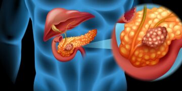 Symptoms of Pancreatic Cancer