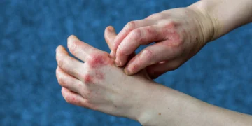 What Is Eczema?