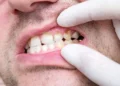 What is Tooth Decay ?