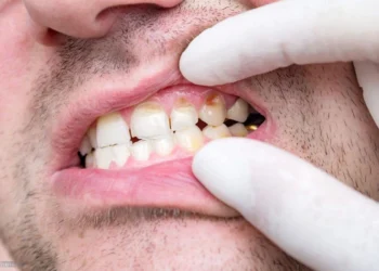 What is Tooth Decay ?