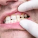 What is Tooth Decay ?