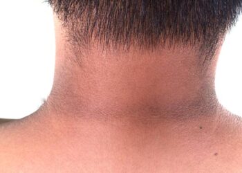 Kulit Leher Gelap Bukan Sekadar Kosmetik: Kenal Pasti Rintangan Insulin