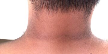 Kulit Leher Gelap Bukan Sekadar Kosmetik: Kenal Pasti Rintangan Insulin