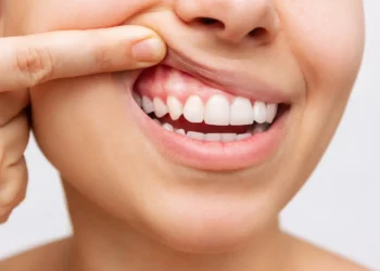 Gusi Mudah Berdarah? Mungkin Badan Kekurangan Vitamin C