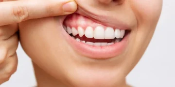 Gusi Mudah Berdarah? Mungkin Badan Kekurangan Vitamin C