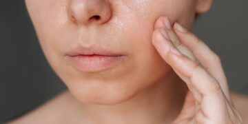 Kulit Muka Berminyak: Hormon Atau Cara Cuci Salah?