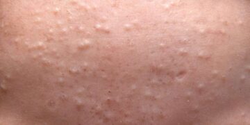 Hilangkan Tiny Bumps Dengan Salicylic & Glycolic Acid!