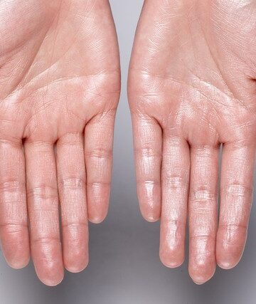 Tapak Tangan Berpeluh Berlebihan: Hormon Atau Anxiety?