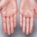 Tapak Tangan Berpeluh Berlebihan: Hormon Atau Anxiety?