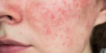 Tanda-Tanda Halus Skin Barrier Rosak Yang Ramai Abaikan