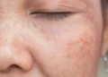 Kesan Sinar UV terhadap Kulit dan Cara Perlindungan yang Berkesan