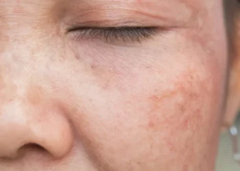 Kesan Sinar UV terhadap Kulit dan Cara Perlindungan yang Berkesan