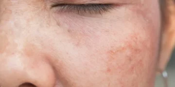 Kesan Sinar UV terhadap Kulit dan Cara Perlindungan yang Berkesan