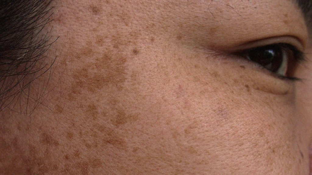 Sinar UV terhadap Kulit