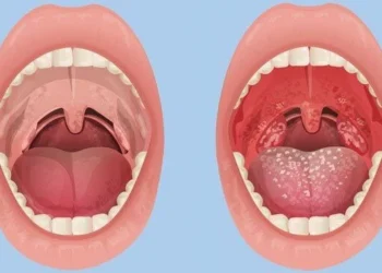 Tonsilitis: Punca Sakit Tekak Berulang Yang Ramai Tak Sedar
