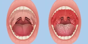 Tonsilitis: Punca Sakit Tekak Berulang Yang Ramai Tak Sedar