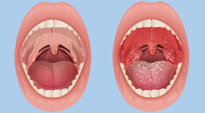 Tonsilitis: Punca Sakit Tekak Berulang Yang Ramai Tak Sedar