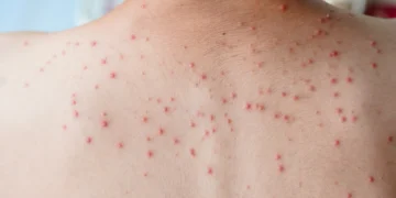 Punca Jerawat Belakang Badan dan Cara Mengatasinya