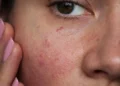 Kulit Sensitif: Apa Yang Perlu Dielakkan?