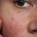 Kulit Sensitif: Apa Yang Perlu Dielakkan?