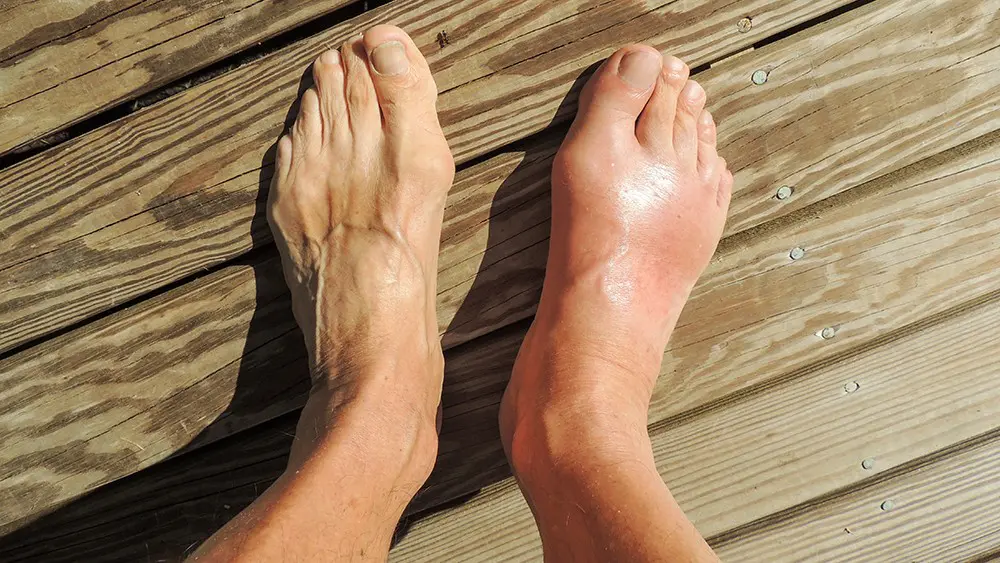 gout